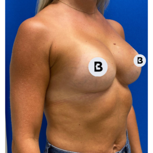 Breast Augmentation Before and After Pictures Buffalo, NY