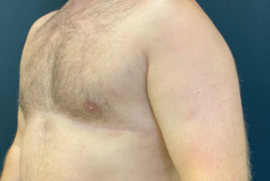 Gynecomastia (Male Chest Surgery) Before and After Pictures Buffalo, NY