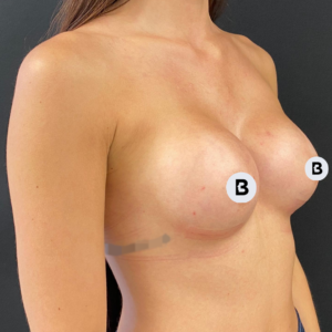 Breast Augmentation Before and After Pictures Buffalo, NY