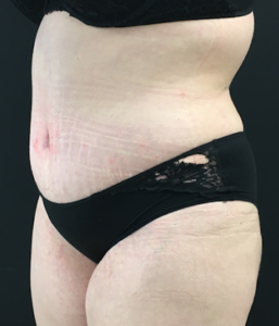 Abdominoplasty (Tummy Tuck) Before and After Pictures Buffalo, NY