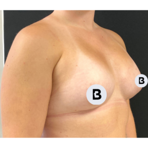 Breast Augmentation Before and After Pictures Buffalo, NY