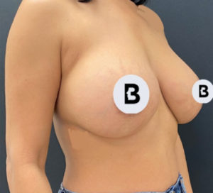 Breast Augmentation Before and After Pictures Buffalo, NY