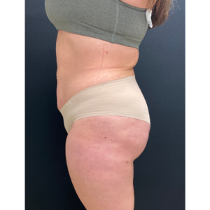 Brazilian Butt Lift Before and After Pictures Buffalo, NY