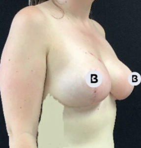 Breast Reduction Before and After Pictures Buffalo, NY