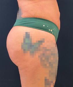 Brazilian Butt Lift Before and After Pictures in Buffalo, NY