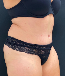 Abdominoplasty (Tummy Tuck) Before and After Pictures Buffalo, NY