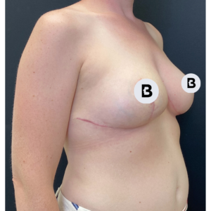 Breast Reduction Before and After Pictures Buffalo, NY