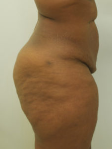 Brazilian Butt Lift Before and After Pictures Buffalo, NY