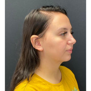 Chin Liposuction Before and After Pictures Buffalo, NY