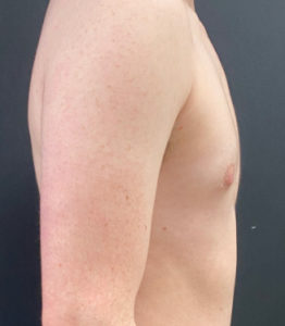 Female to Male Top Surgery Before and After Pictures Buffalo, NY