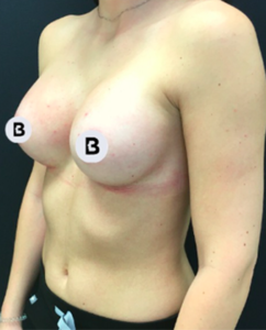 Breast Augmentation Before and After Pictures Buffalo, NY