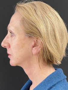 Facelift Before and After Pictures in Buffalo, NY