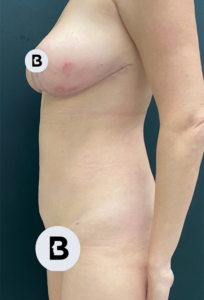 Liposuction Before and After Pictures in Buffalo, NY