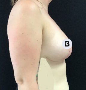 Breast Reduction Before and After Pictures Buffalo, NY
