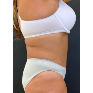 Abdominoplasty (Tummy Tuck) Before and After Pictures Buffalo, NY