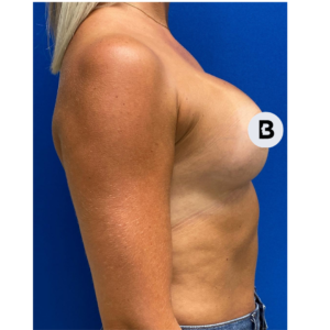 Breast Augmentation Before and After Pictures Buffalo, NY