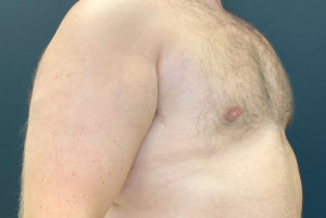 Gynecomastia (Male Chest Surgery) Before and After Pictures Buffalo, NY