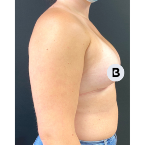 Breast Augmentation Before and After Pictures Buffalo, NY