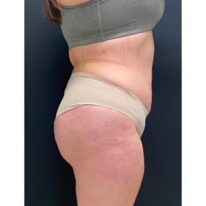 Brazilian Butt Lift Before and After Pictures Buffalo, NY