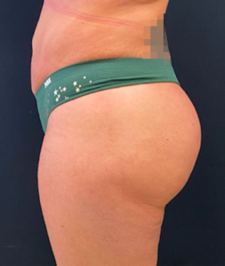 Brazilian Butt Lift Before and After Pictures in Buffalo, NY