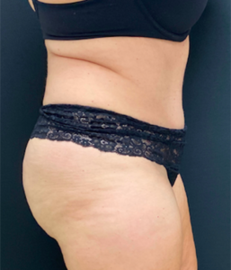 Abdominoplasty (Tummy Tuck) Before and After Pictures Buffalo, NY