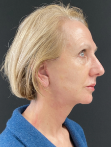 Facelift Before and After Pictures in Buffalo, NY