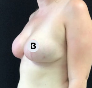 Breast Reduction Before and After Pictures Buffalo, NY