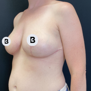 Mastopexy (Breast Lift) Before and After Pictures Buffalo, NY