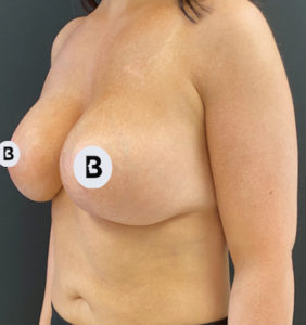Breast Augmentation Before and After Pictures Buffalo, NY