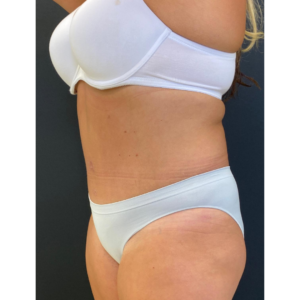Abdominoplasty (Tummy Tuck) Before and After Pictures Buffalo, NY