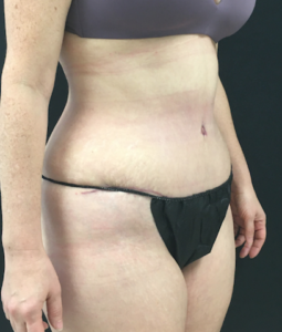 Abdominoplasty (Tummy Tuck) Before and After Pictures Buffalo, NY