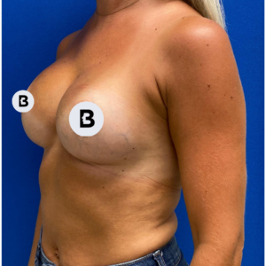 Breast Augmentation Before and After Pictures Buffalo, NY