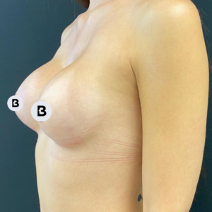 Breast Augmentation Before and After Pictures Buffalo, NY
