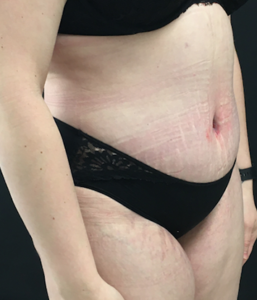 Abdominoplasty (Tummy Tuck) Before and After Pictures Buffalo, NY