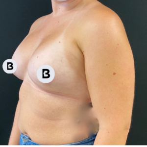 Breast Augmentation Before and After Pictures Buffalo, NY