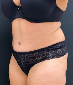 Abdominoplasty (Tummy Tuck) Before and After Pictures Buffalo, NY