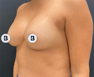 Breast Augmentation Before and After Pictures Buffalo, NY