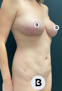 Liposuction Before and After Pictures in Buffalo, NY