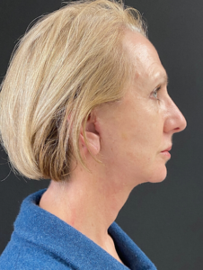 Facelift Before and After Pictures in Buffalo, NY