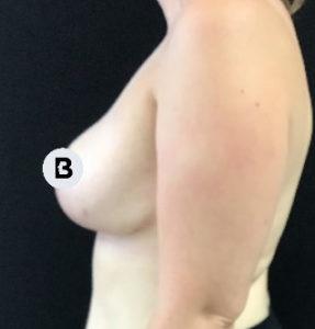 Breast Reduction Before and After Pictures Buffalo, NY