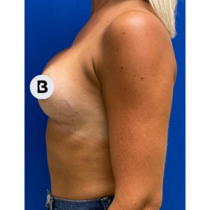 Breast Augmentation Before and After Pictures Buffalo, NY