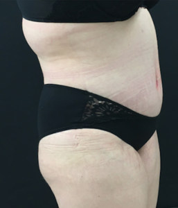 Abdominoplasty (Tummy Tuck) Before and After Pictures Buffalo, NY