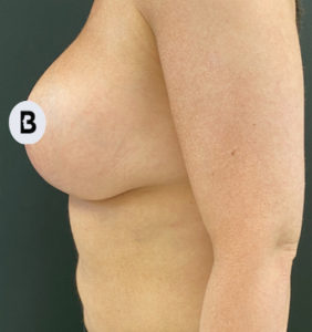 Breast Augmentation Before and After Pictures Buffalo, NY