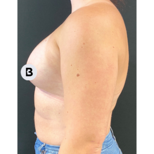 Breast Augmentation Before and After Pictures Buffalo, NY