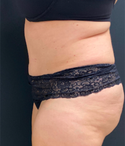 Abdominoplasty (Tummy Tuck) Before and After Pictures Buffalo, NY