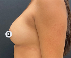 Breast Augmentation Before and After Pictures Buffalo, NY