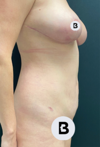 Liposuction Before and After Pictures in Buffalo, NY