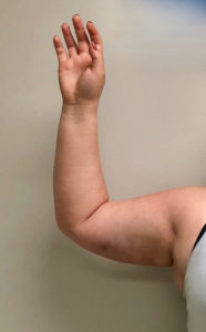 Arm Liposuction Before and After Pictures Buffalo, NY