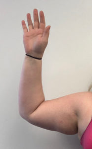 Arm Liposuction Before and After Pictures Buffalo, NY