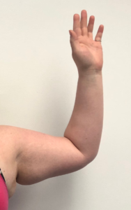 Arm Liposuction Before and After Pictures Buffalo, NY